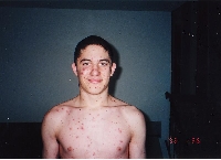 Chicken Pox are sick!